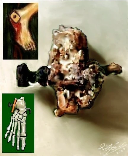 A bone with a nail in it and 2 inset pictures. One of insets is artwork of a skelton foot with a nail in it. The other is what the foot likely looked like with blood streaming off of it.